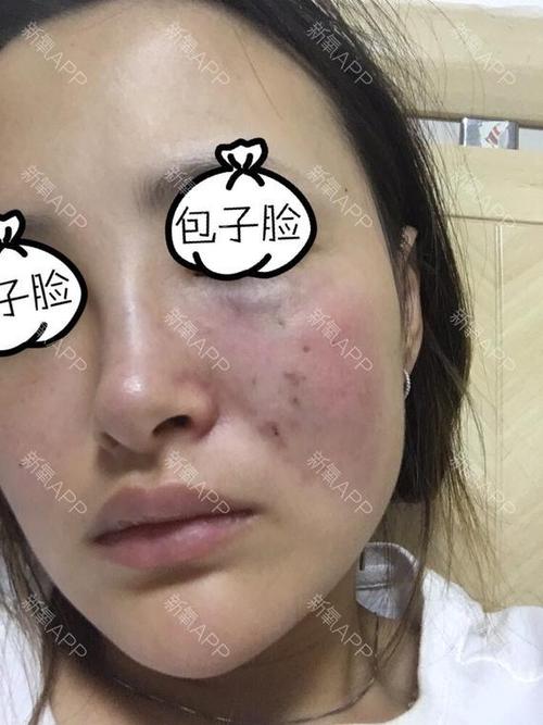 想打玻尿酸，哪里好啊？