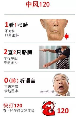 脑梗塞最佳治疗方法