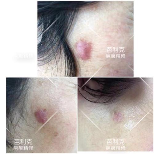 有谁了解帅霓鸿生长因子的功效，是否可以治疗老化及疤痕\色素皮肤