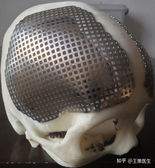 PEEK颅骨修补片有哪些品牌