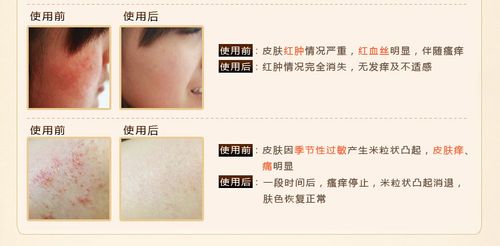 贝母舒敏膏有用过的没啊，它对红血丝有没有效果啊？