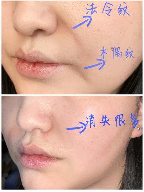 嘴角纹怎么去除 4种方法有效去除嘴角纹