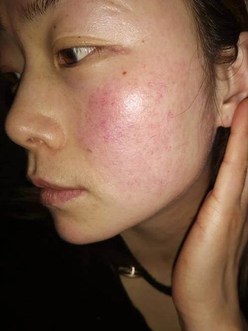 脸上一直都有的红血丝怎样才能完全去除？