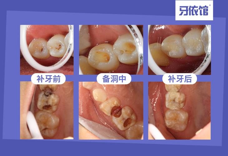 补牙，树脂材料总是粘器械怎么办？