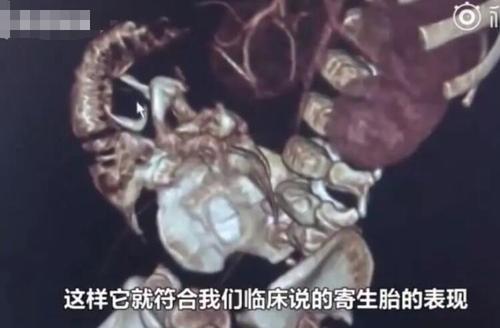 世界罕见的胎中胎是什么？