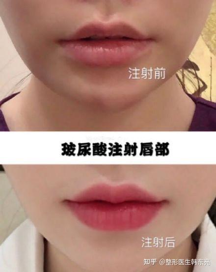 唐山玻尿酸丰唇多少钱一针，请教一下？