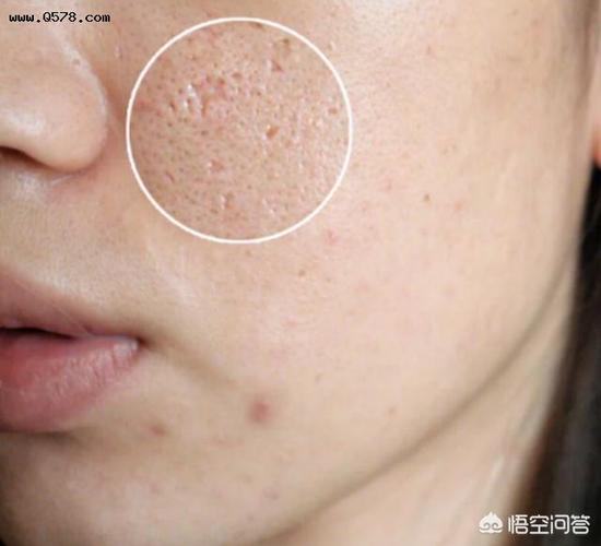 脸上毛孔粗大，有什么秘方？