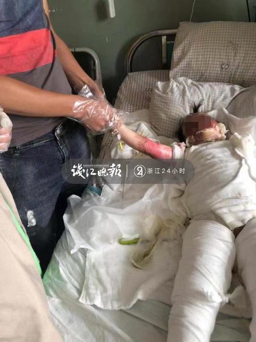 浙江台州2岁女童摔进170度油锅中，治好后小孩子的心理会受到哪些影响？