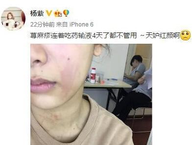 杨紫得荨麻疹吃药输液4天不管用 荨麻疹怎么治疗