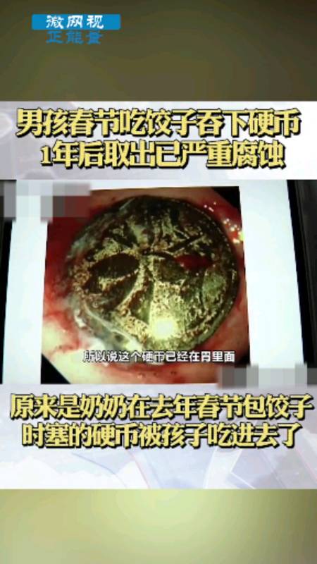 河南男孩春节吃饺子吞下硬币，1年后取出已严重腐蚀，为何在一年后才发现？
