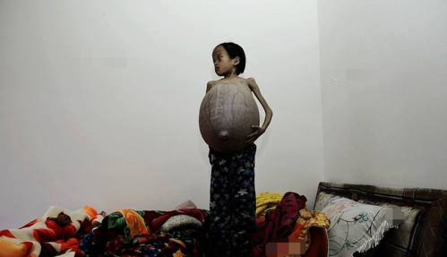 11岁女生，往屁股灌水，肚子鼓起来像篮球还大。会不会爆炸？