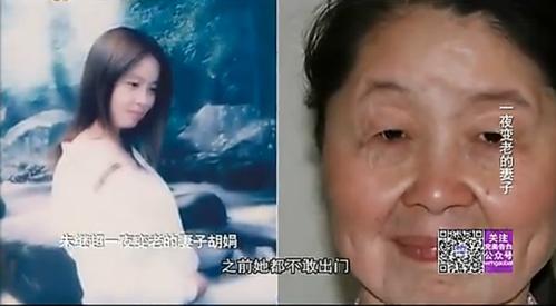 中国早衰症女孩胡娟的丈夫不嫌弃她吗