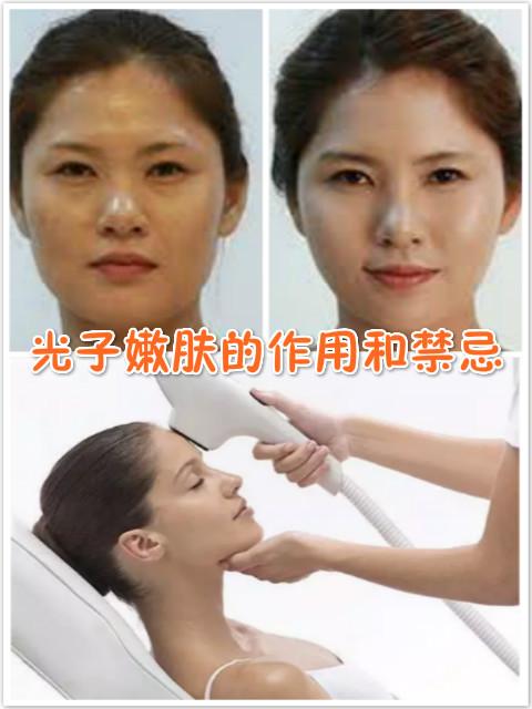 光子嫩肤主要有什么功效啊？