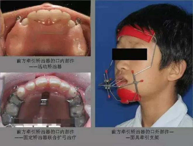 15岁地包天可以采用外置牵引矫正器吗？