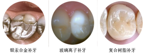 玻璃离子是永久补牙材料吗
