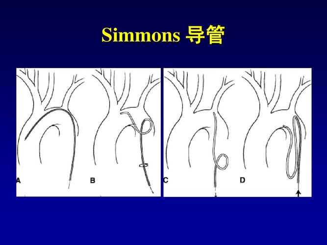 介入导管分类及用途