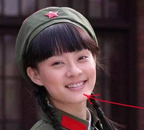 孙俪下巴的痣怎么回事？