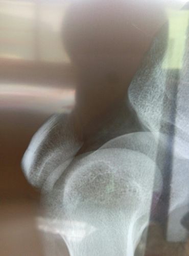 腿弯长骨刺