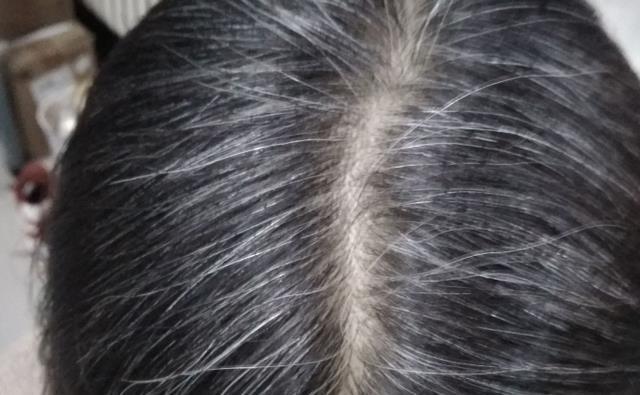 白头发越拔越多是真的嘛？