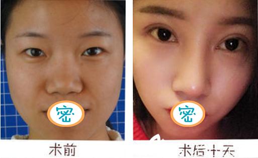 成都艺星是正规医院吗，双眼皮做的怎么样？