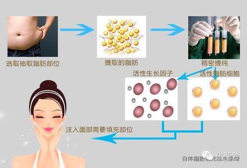 游离脂肪颗粒的自体移植是指将人体哪里的脂肪，用什么方法吸出？