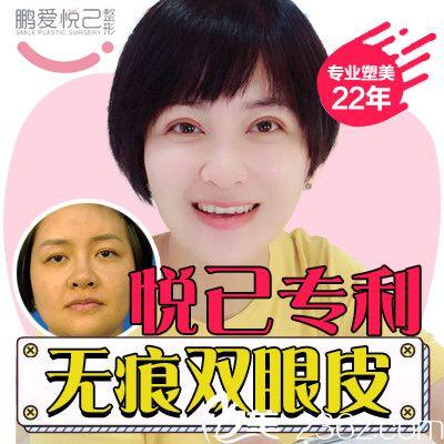 深圳鹏爱医疗美容医院 做双眼皮需要花多少钱呢 效果怎么样啊？